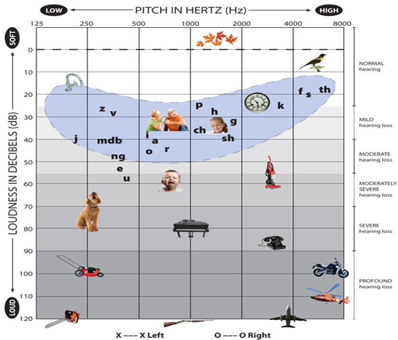 Hearing Loss Severity Chart